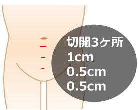 腹腔鏡下ヘルニア根治術TEP法