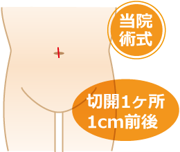 単孔式腹腔鏡下鼠径ヘルニア根治術SILS-TEP法